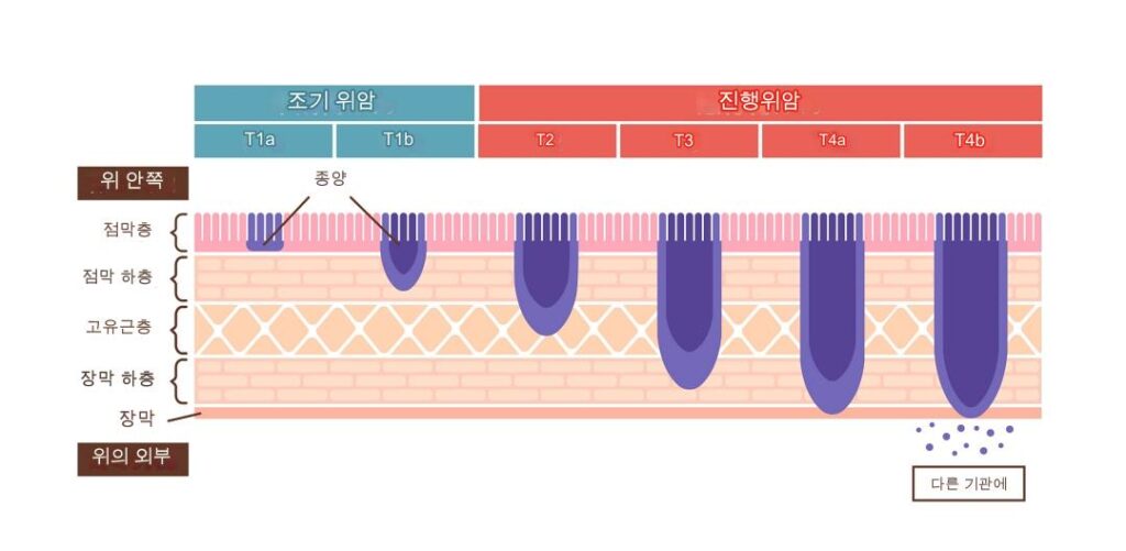 위암초기증상