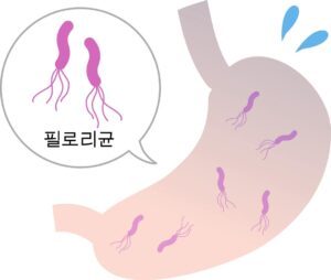 위암초기증상